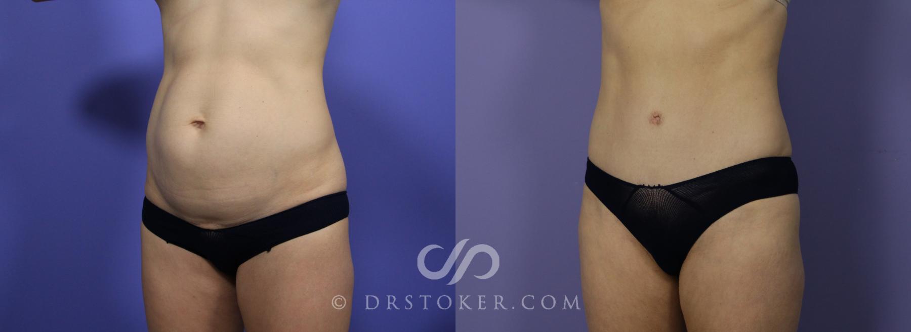 Before & After Tummy Tuck Case 1183 View #3 View in Los Angeles, CA