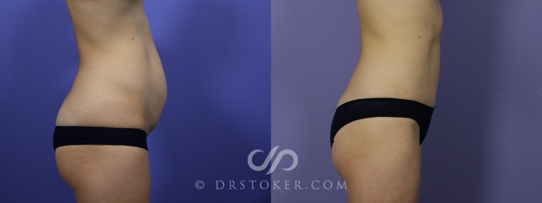 Before & After Tummy Tuck Case 1183 View #4 View in Los Angeles, CA