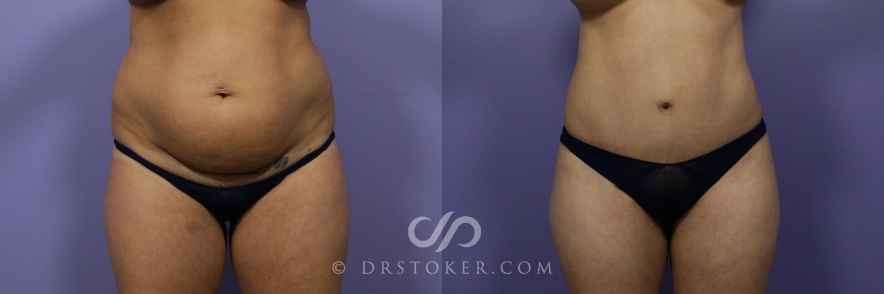 Before & After Tummy Tuck Case 1184 View #1 View in Los Angeles, CA