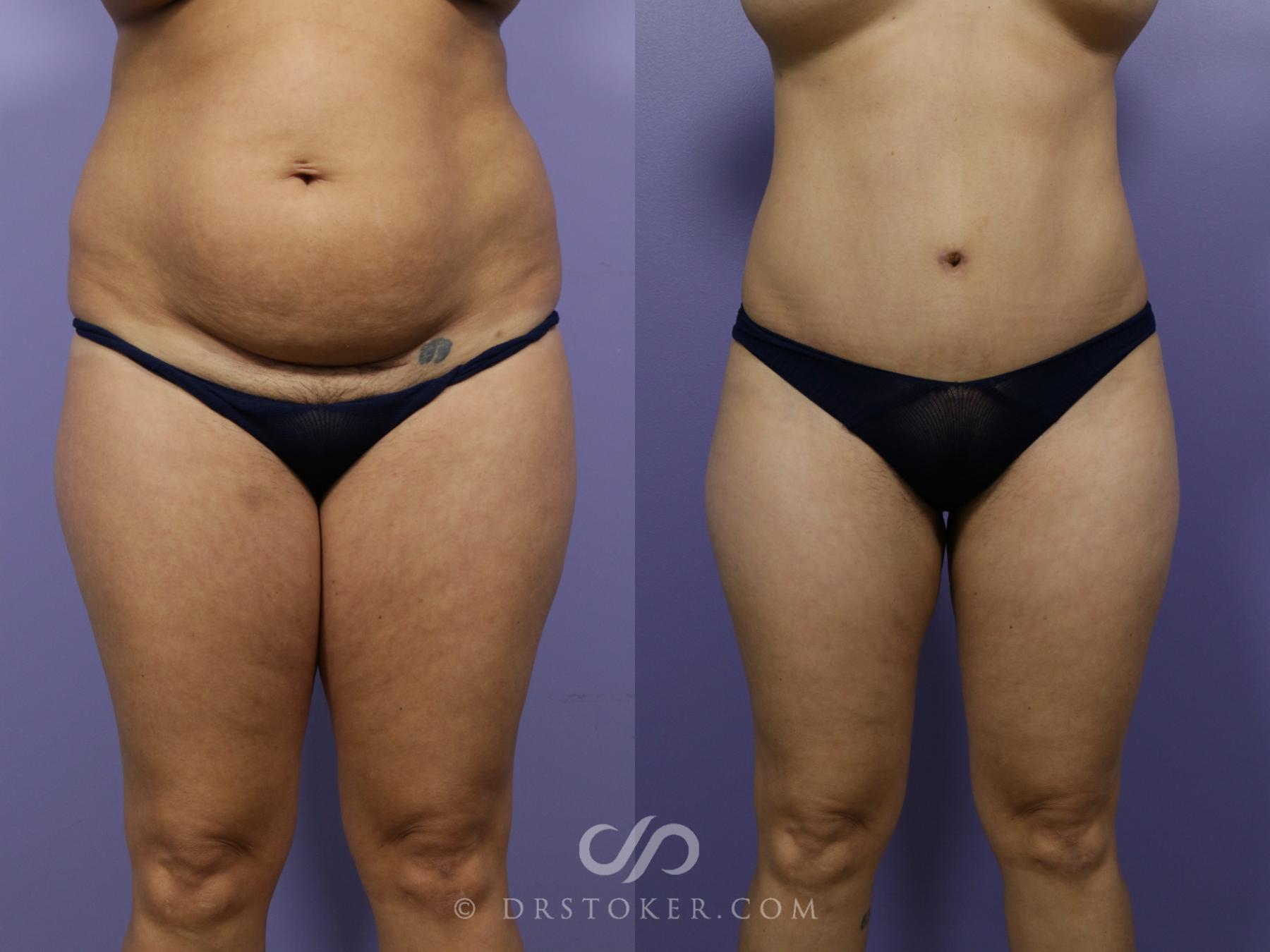 Before & After Tummy Tuck Case 1184 View #2 View in Los Angeles, CA