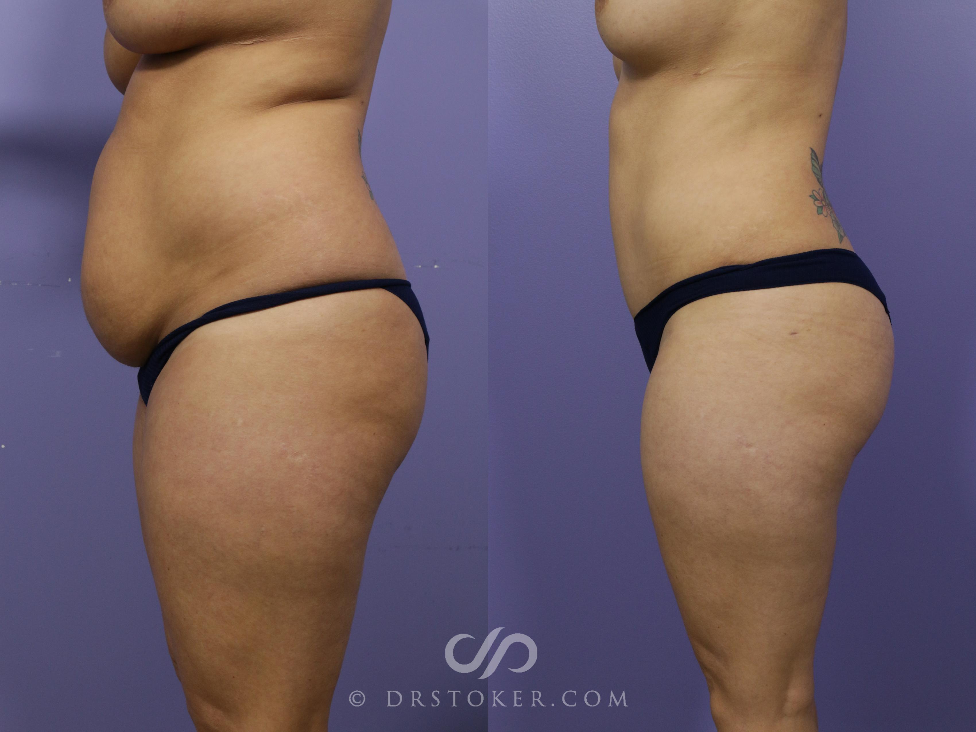 Before & After Tummy Tuck Case 1184 View #3 View in Los Angeles, CA