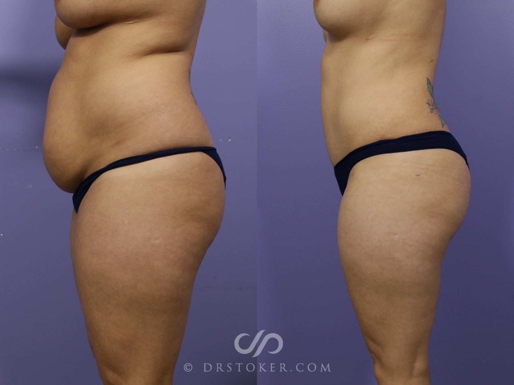 Before & After Tummy Tuck Case 1184 View #3 View in Los Angeles, CA