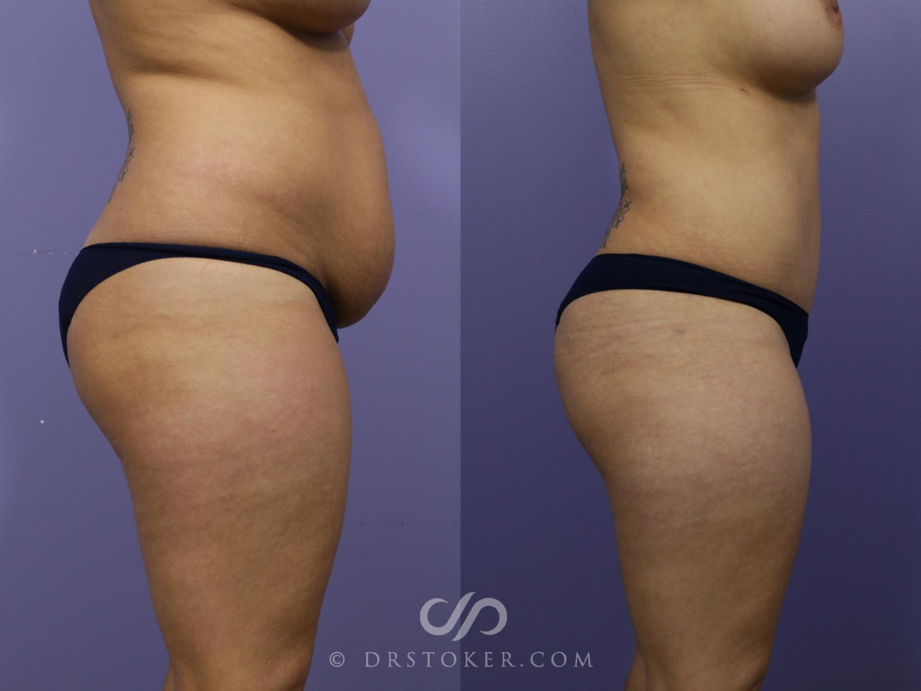 Before & After Tummy Tuck Case 1184 View #4 View in Los Angeles, CA
