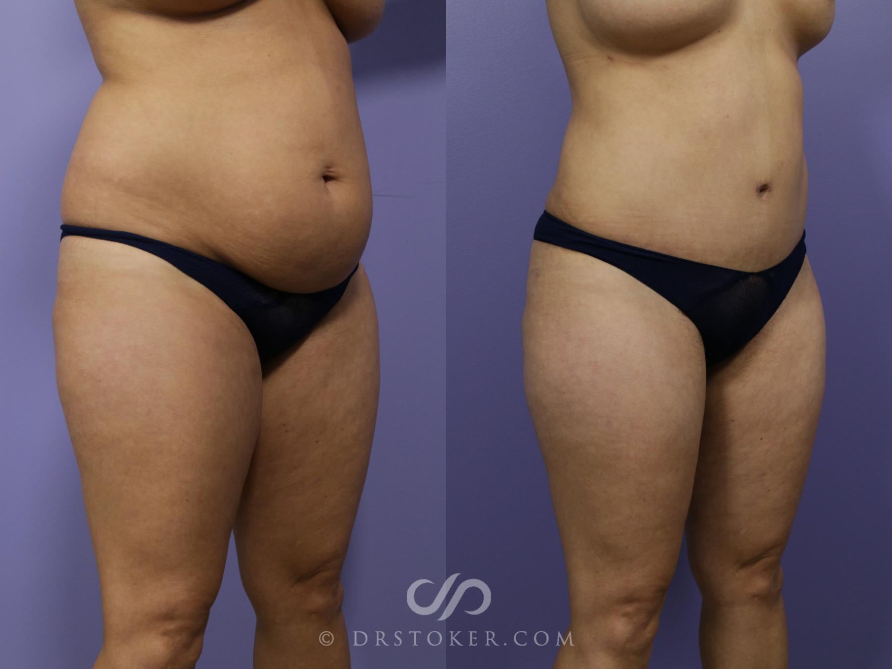 Before & After Tummy Tuck Case 1184 View #5 View in Los Angeles, CA
