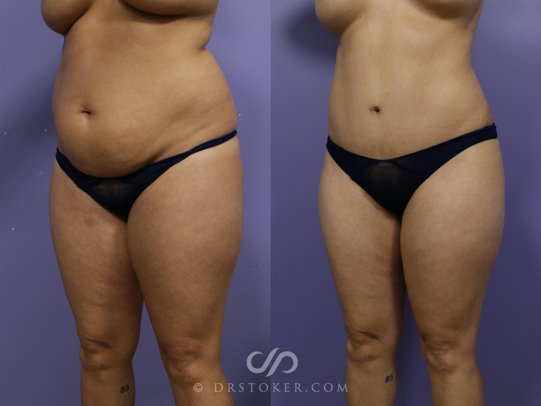 Before & After Tummy Tuck Case 1184 View #6 View in Los Angeles, CA