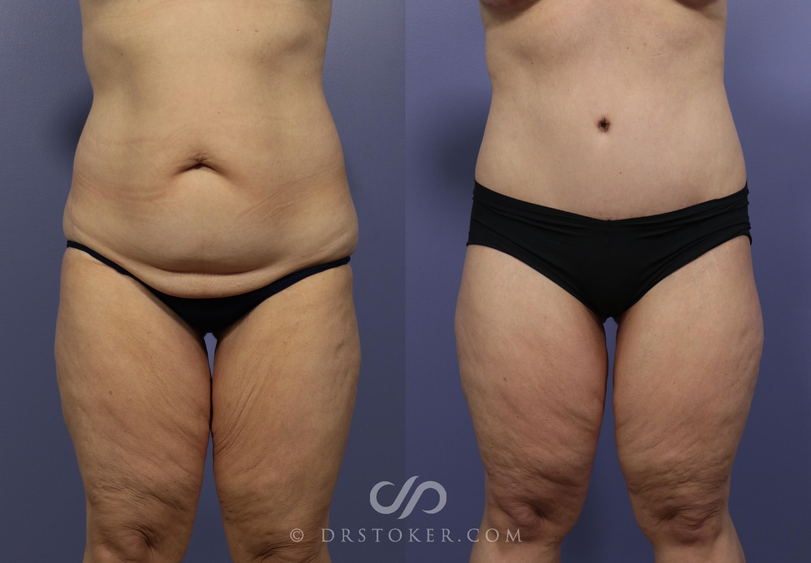 Before & After Tummy Tuck Case 1185 View #1 View in Los Angeles, CA