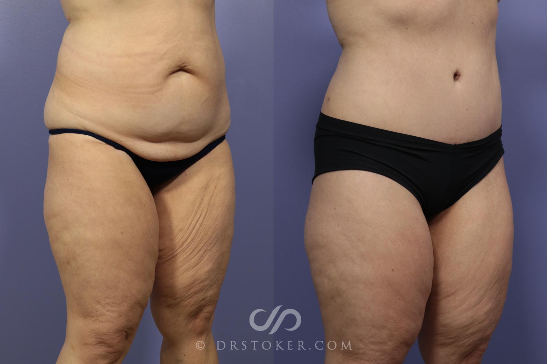 Before & After Tummy Tuck Case 1185 View #2 View in Los Angeles, CA