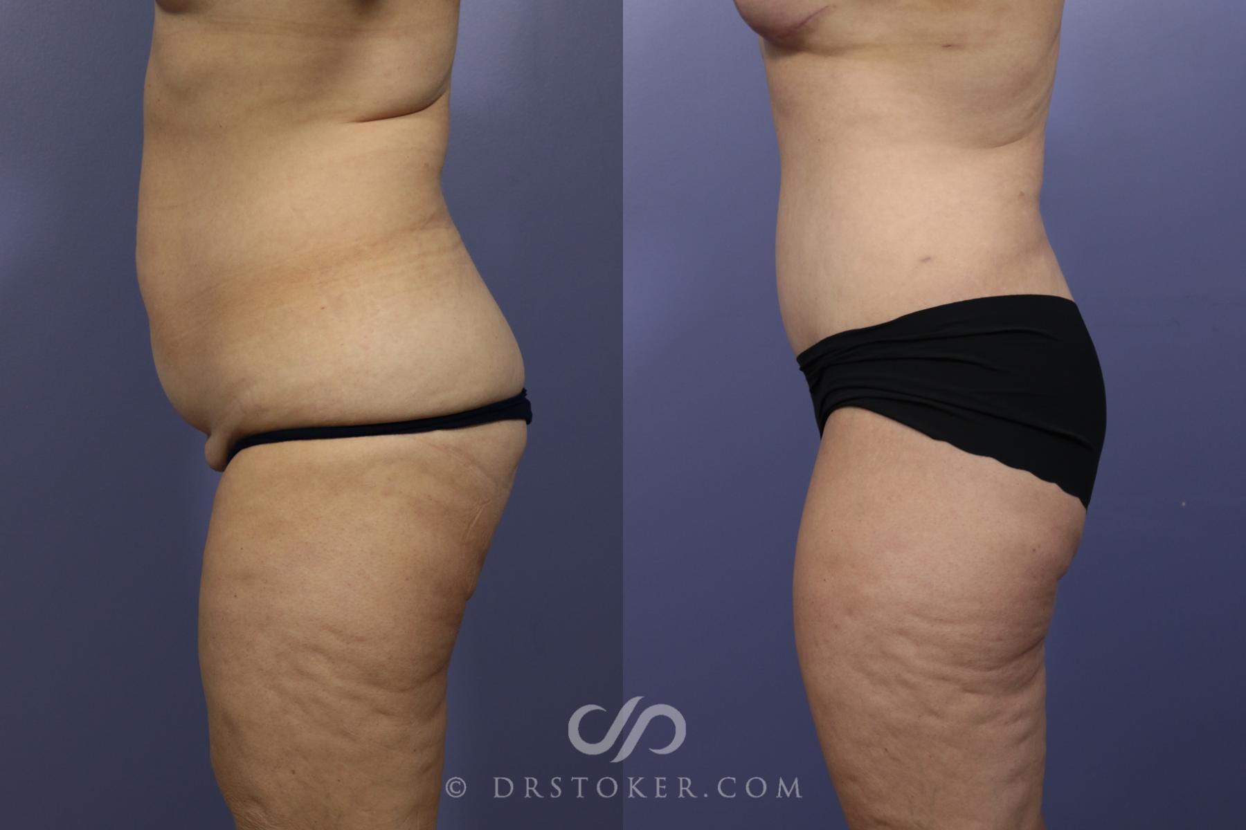 Before & After Tummy Tuck Case 1185 View #3 View in Los Angeles, CA