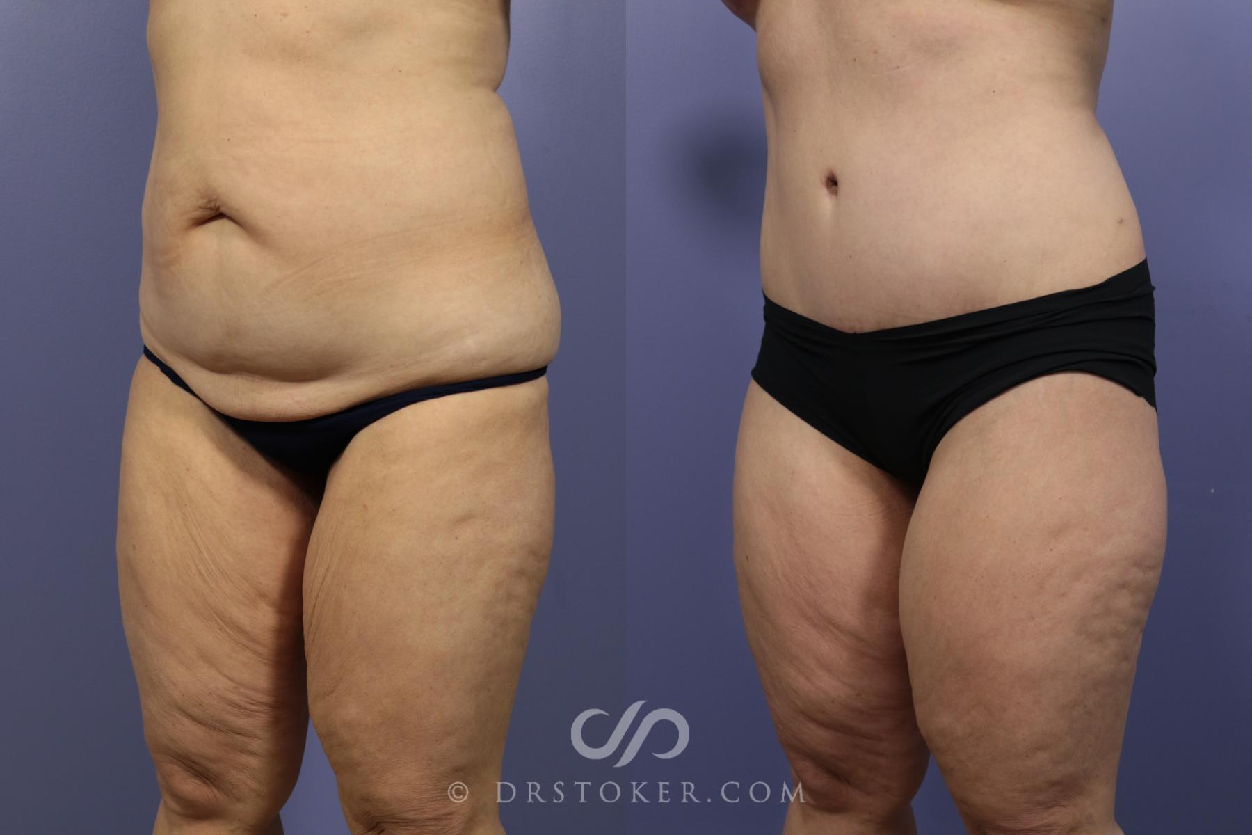 Before & After Tummy Tuck Case 1185 View #4 View in Los Angeles, CA