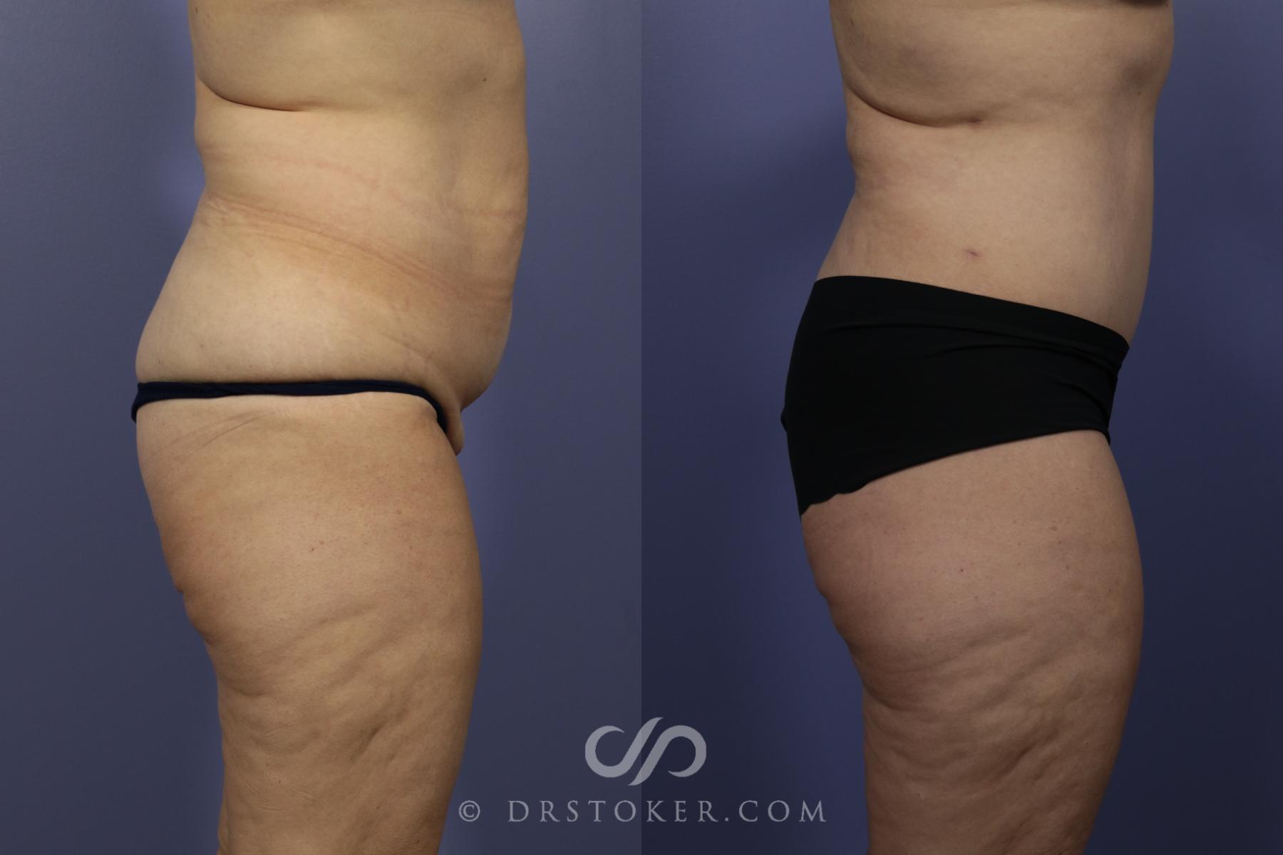 Before & After Tummy Tuck Case 1185 View #5 View in Los Angeles, CA