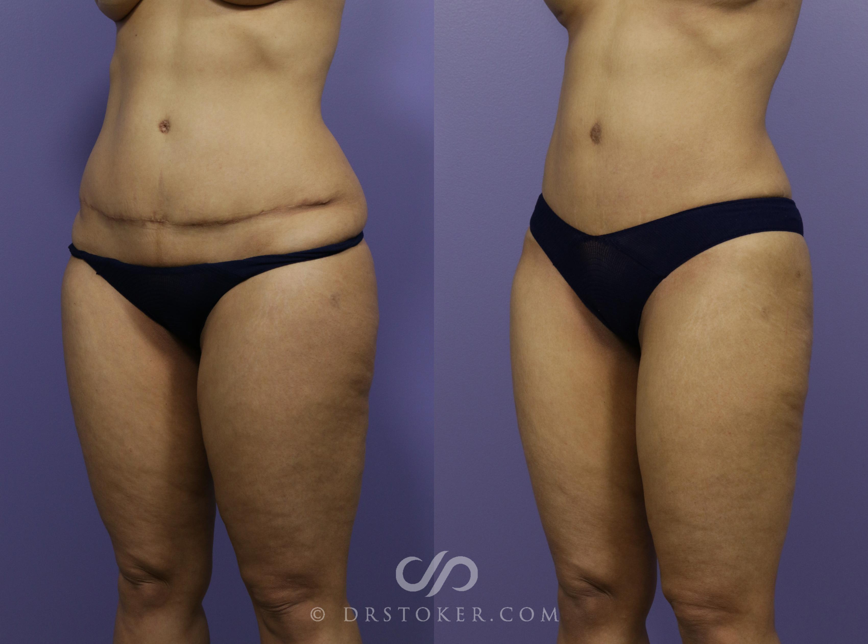 Before & After Tummy Tuck Case 1186 View #2 View in Los Angeles, CA