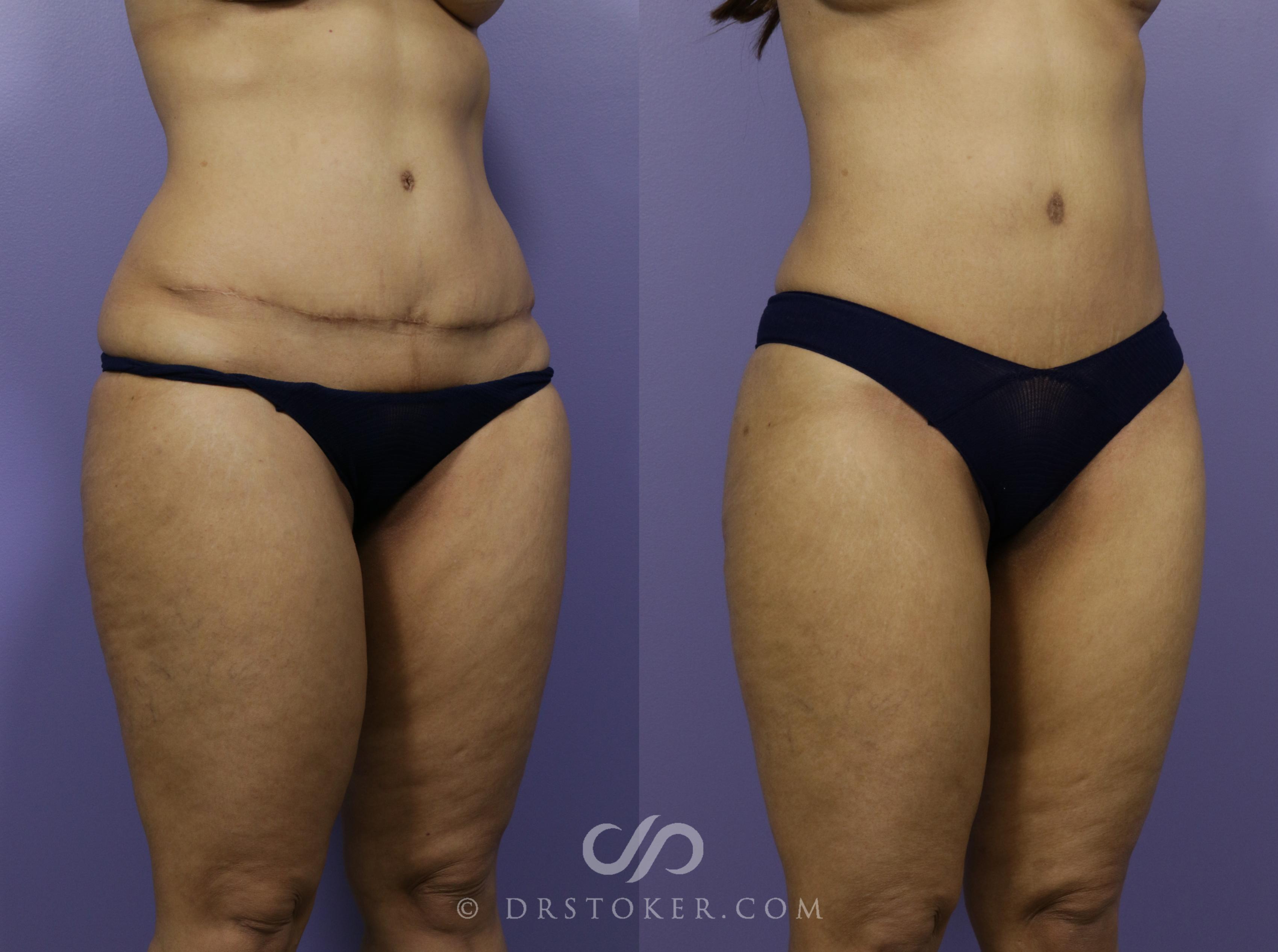 Before & After Tummy Tuck Case 1186 View #3 View in Los Angeles, CA