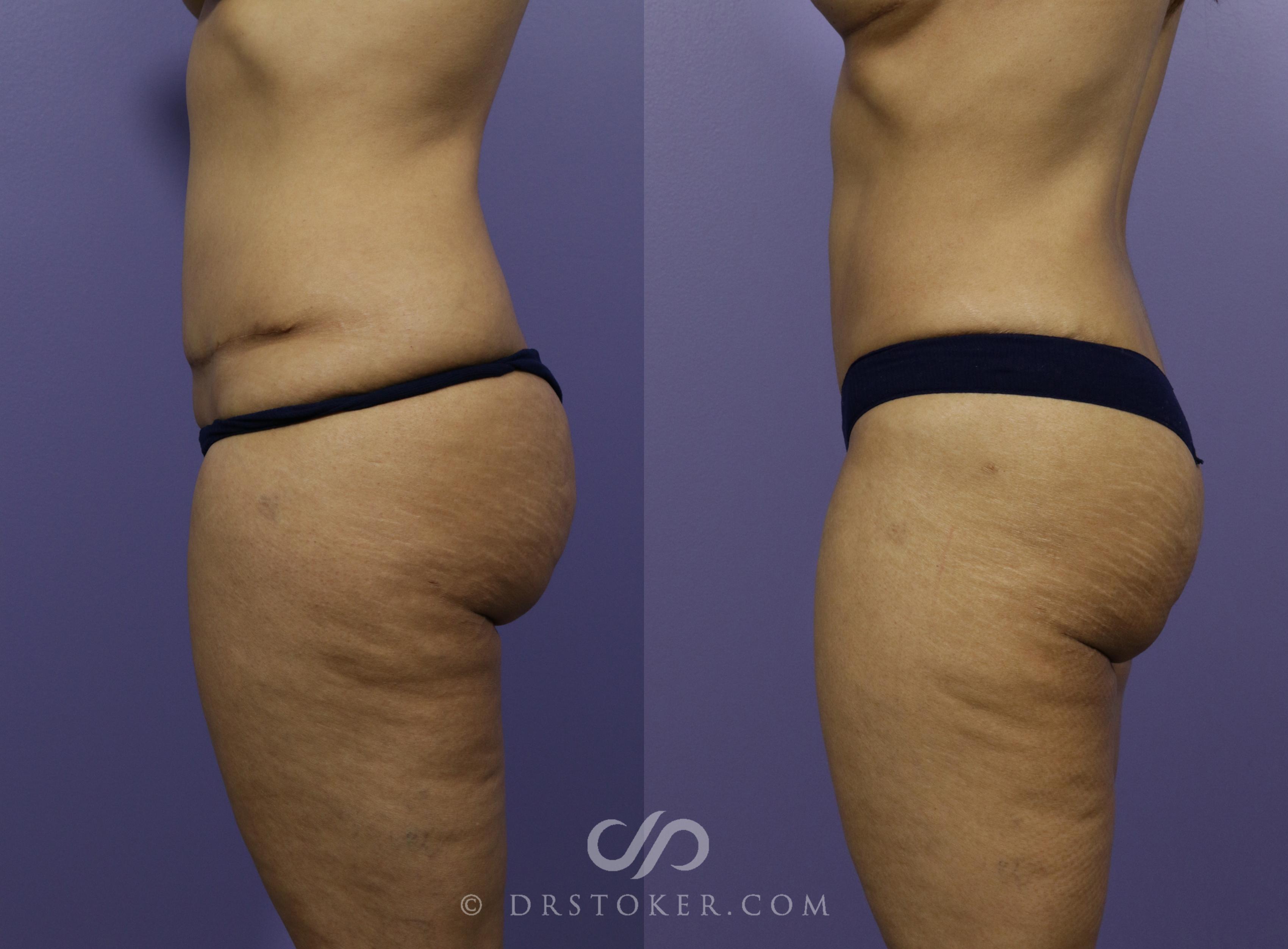 Before & After Tummy Tuck Case 1186 View #4 View in Los Angeles, CA