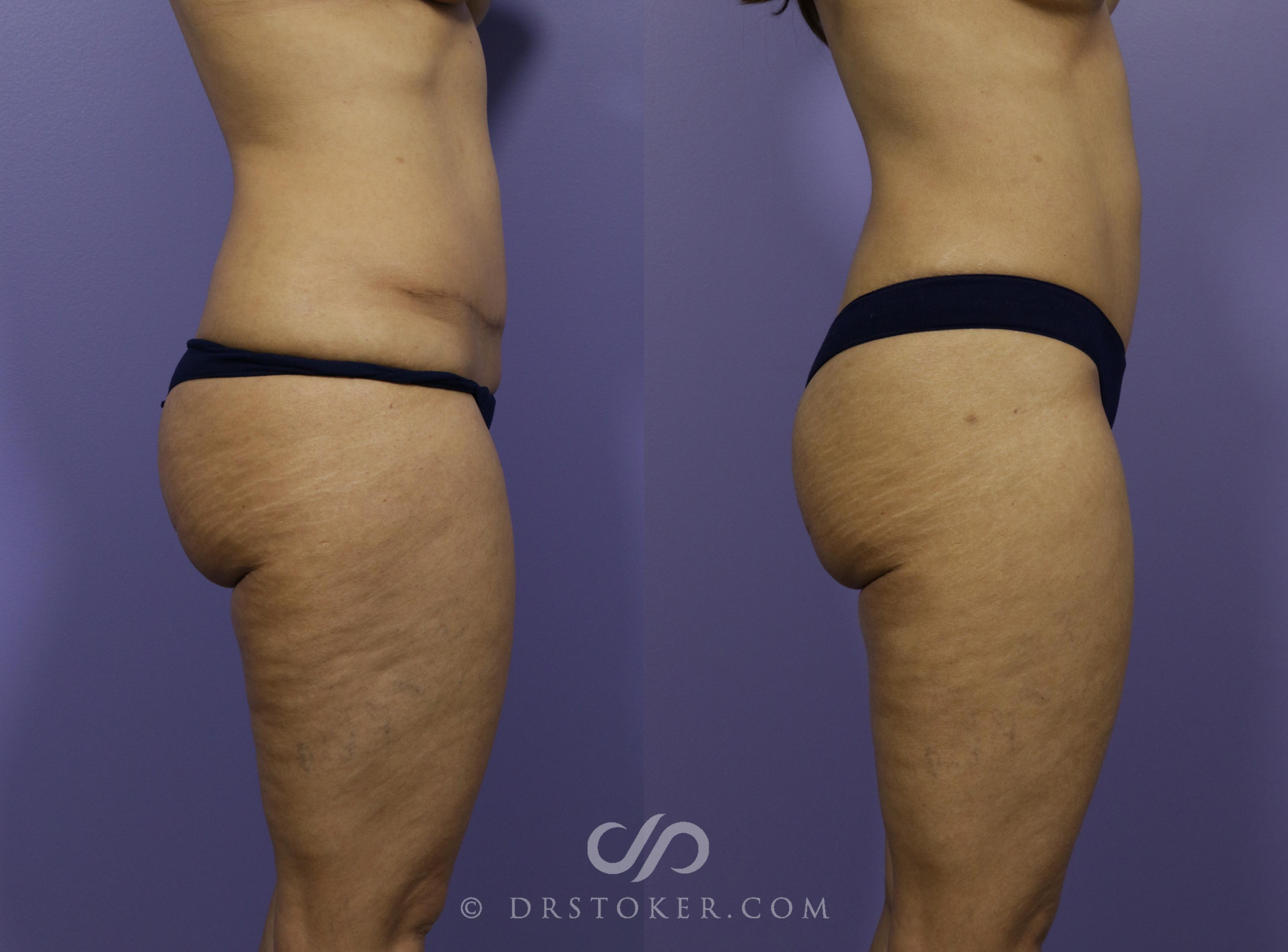 Before & After Tummy Tuck Case 1186 View #5 View in Los Angeles, CA