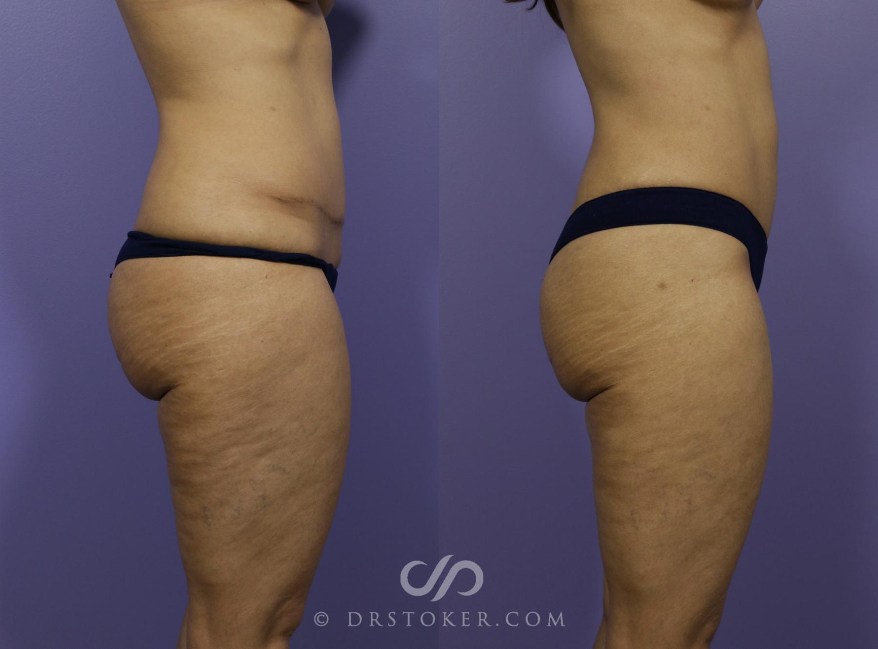 Before & After Tummy Tuck Case 1186 View #5 View in Los Angeles, CA