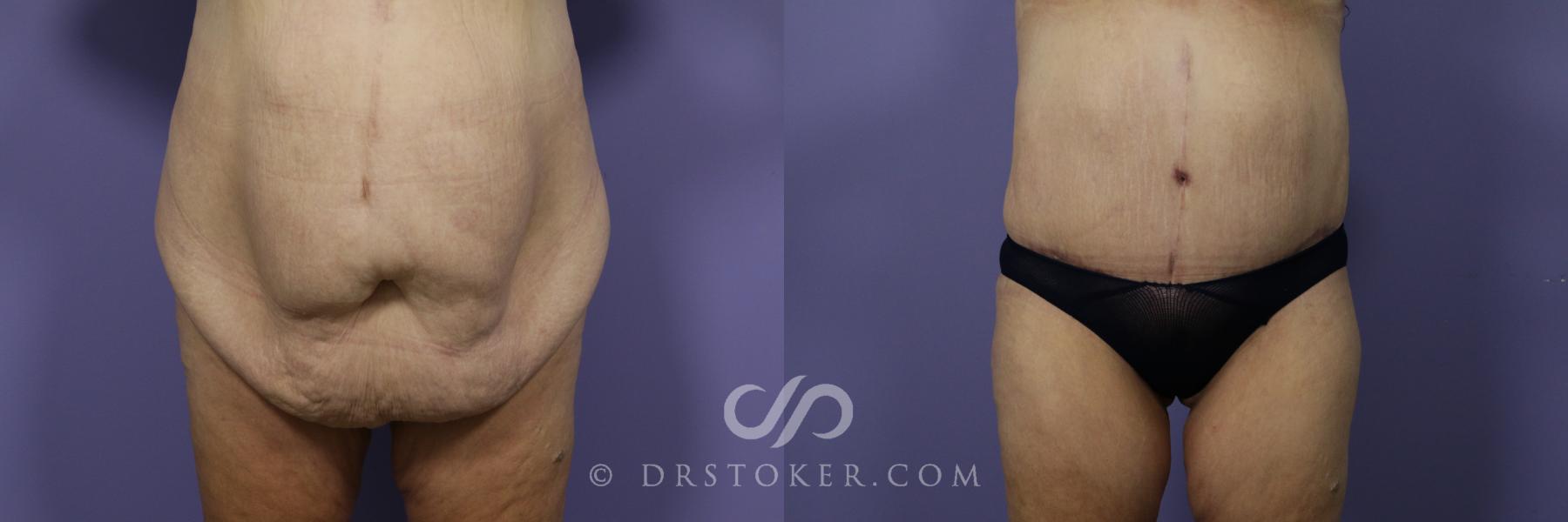Before & After Tummy Tuck Case 1187 View #1 View in Los Angeles, CA