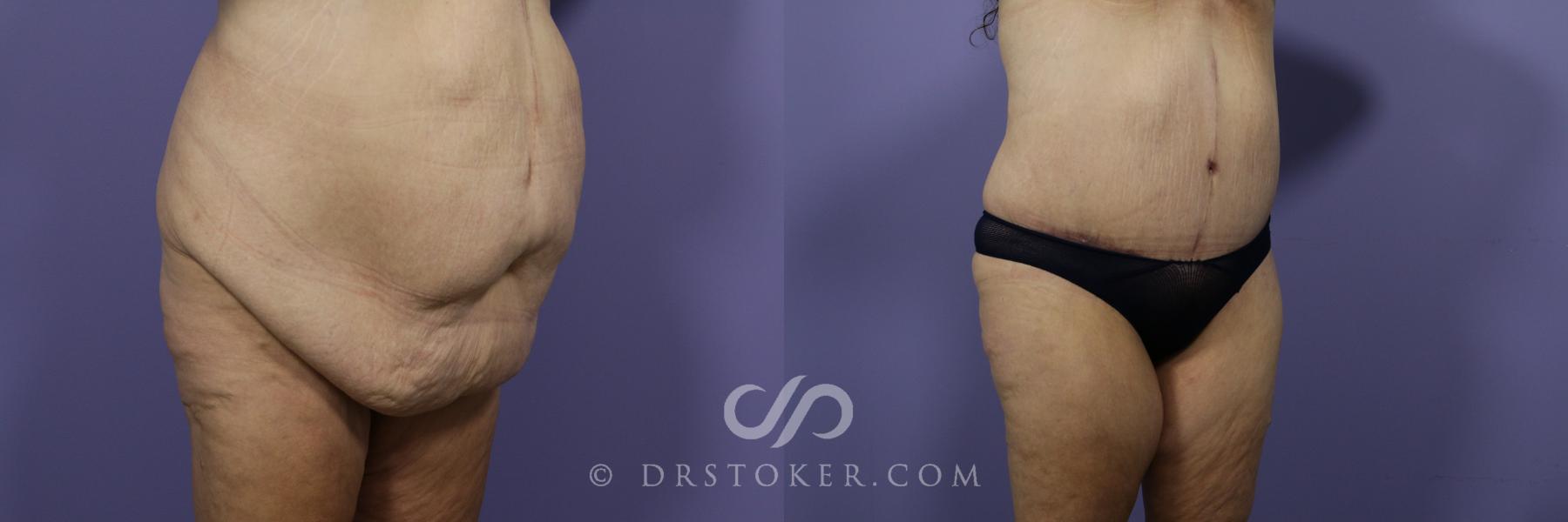 Before & After Tummy Tuck Case 1187 View #2 View in Los Angeles, CA