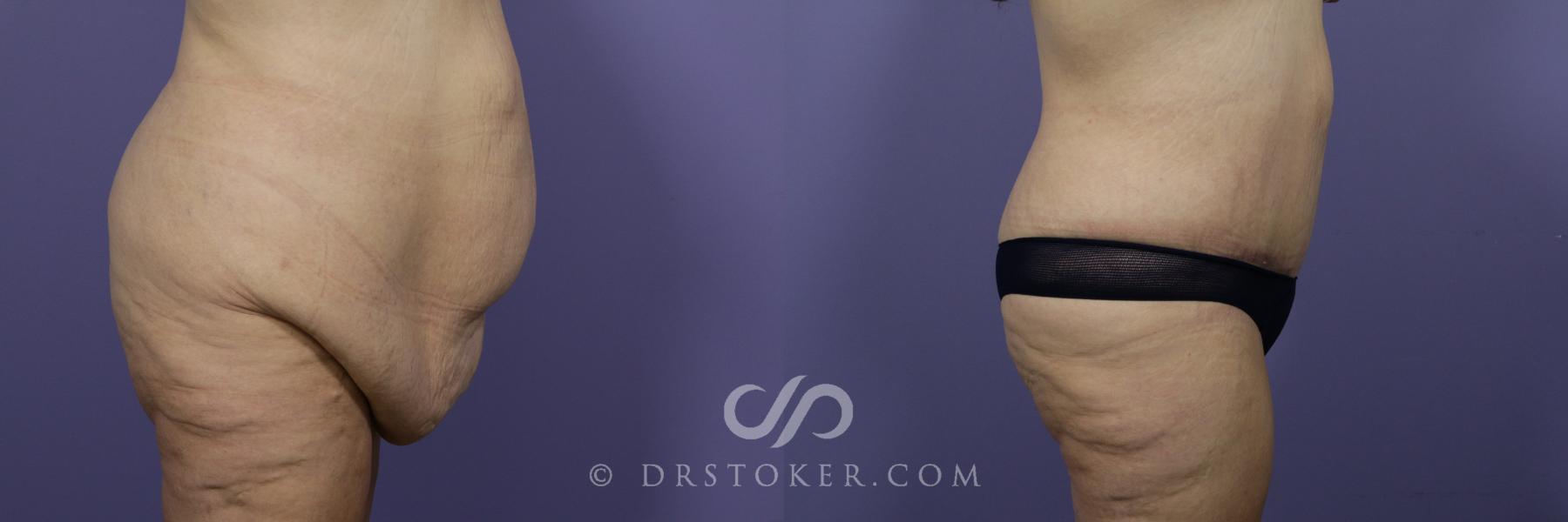 Before & After Tummy Tuck Case 1187 View #3 View in Los Angeles, CA