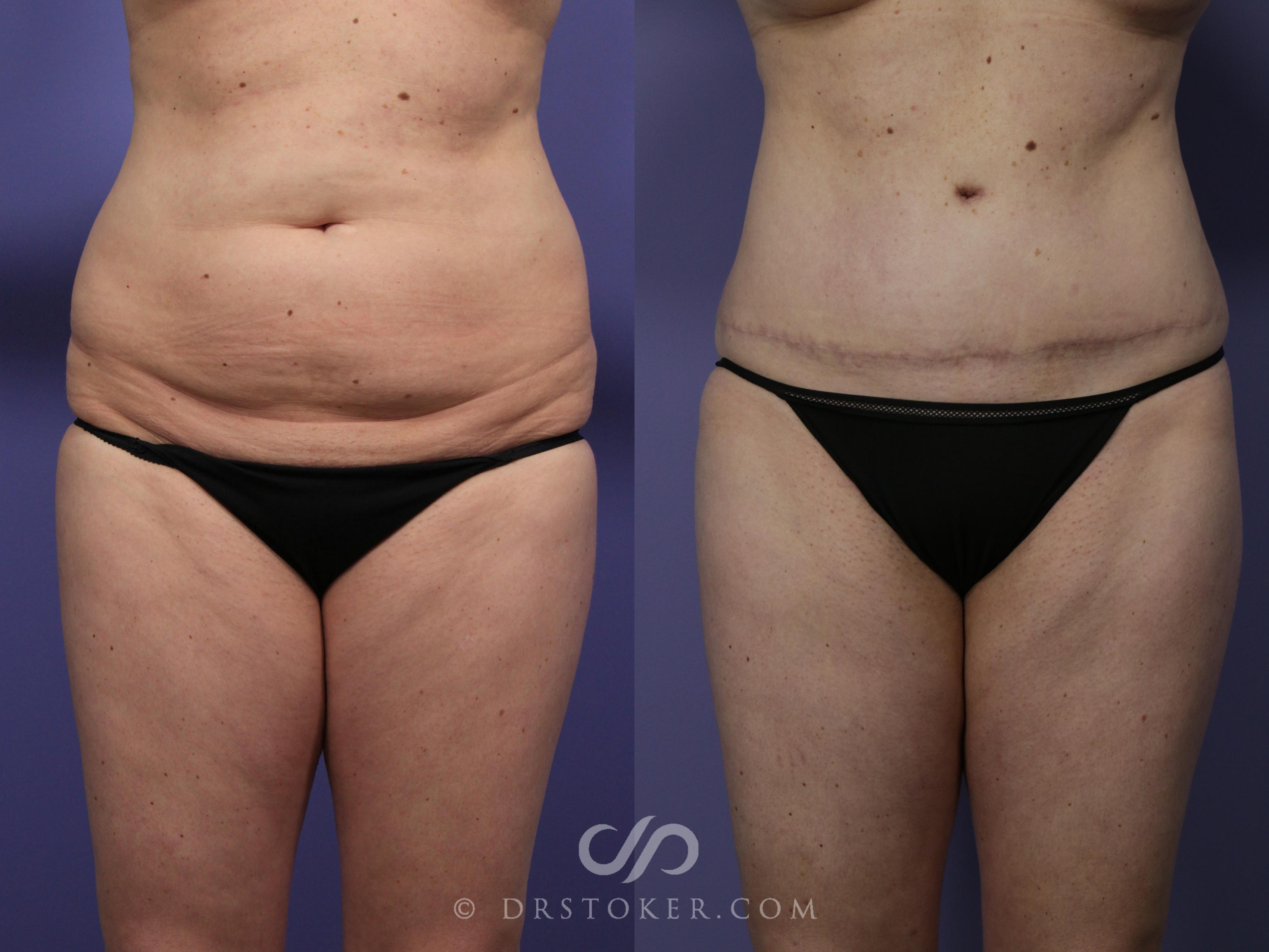 Before & After Tummy Tuck Case 1188 View #1 View in Los Angeles, CA