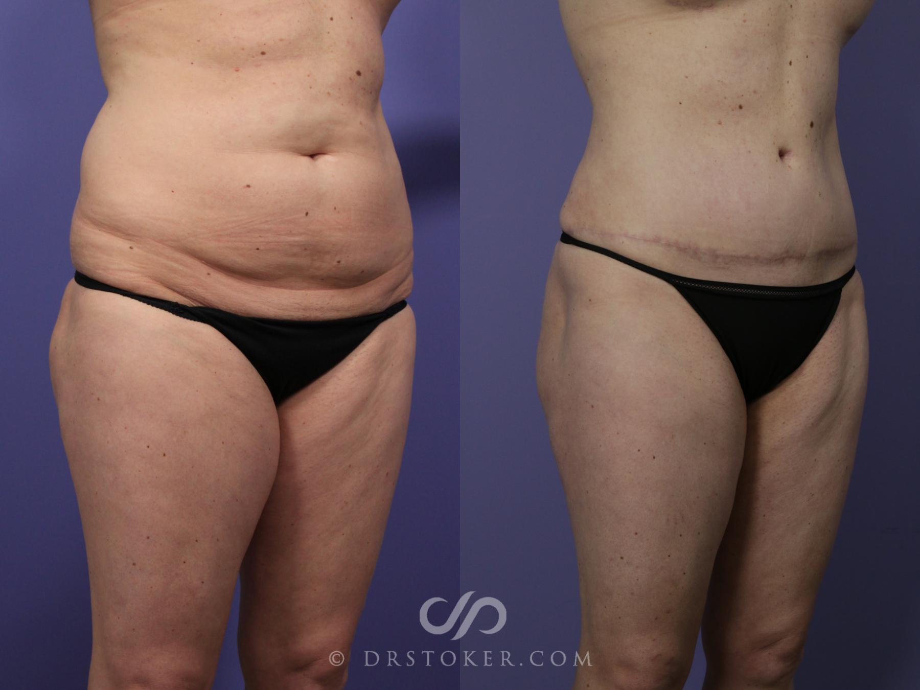 Before & After Tummy Tuck Case 1188 View #2 View in Los Angeles, CA