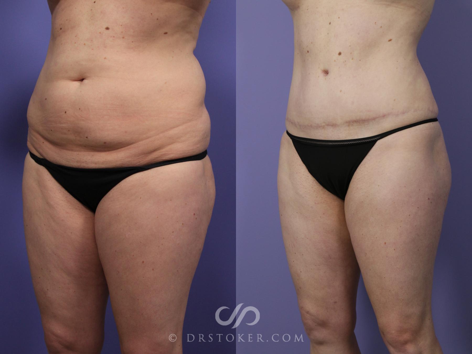 Before & After Tummy Tuck Case 1188 View #3 View in Los Angeles, CA