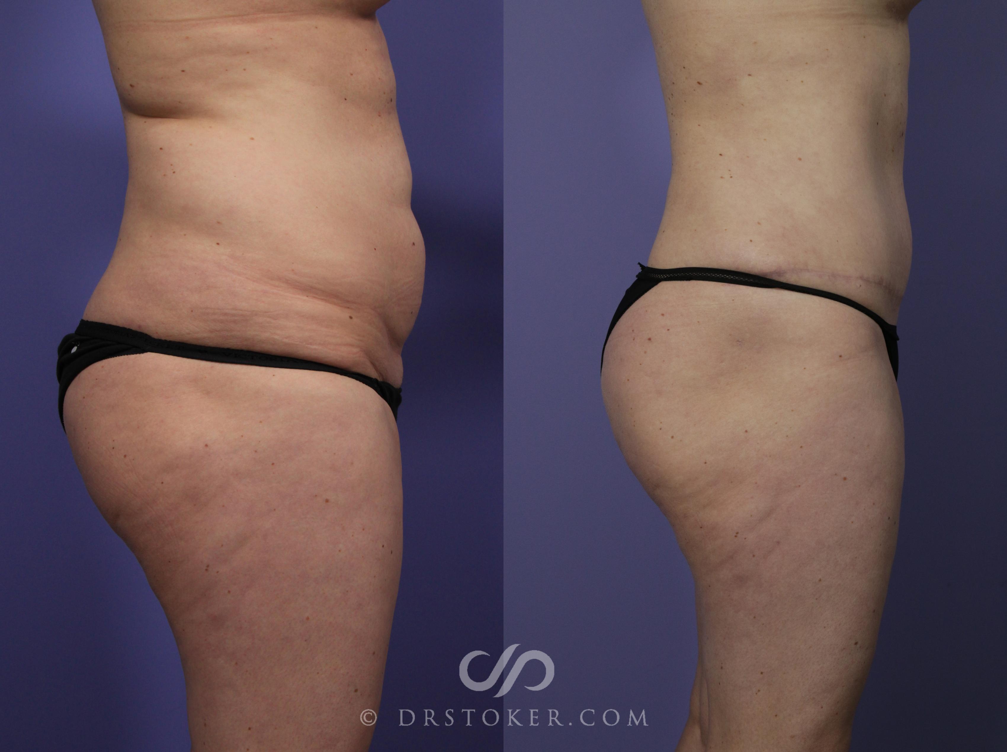 Before & After Tummy Tuck Case 1188 View #4 View in Los Angeles, CA