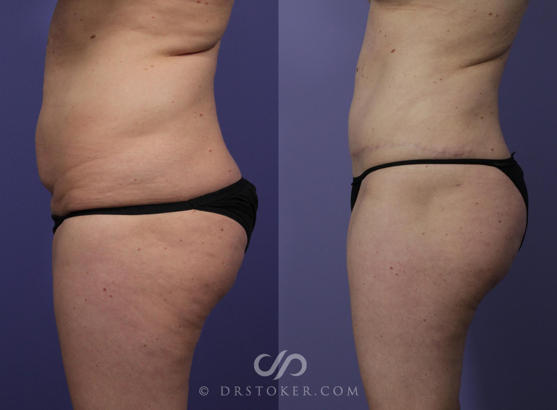 Before & After Tummy Tuck Case 1188 View #5 View in Los Angeles, CA