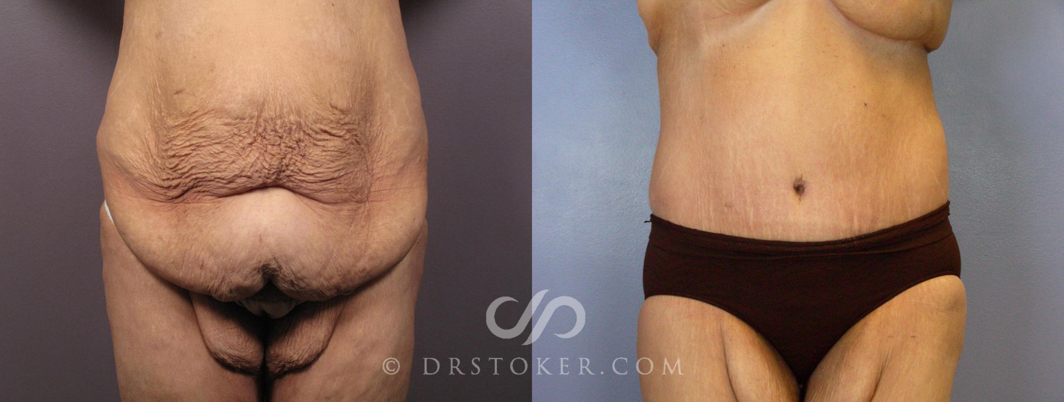 Before & After Tummy Tuck Case 119 View #1 View in Los Angeles, CA
