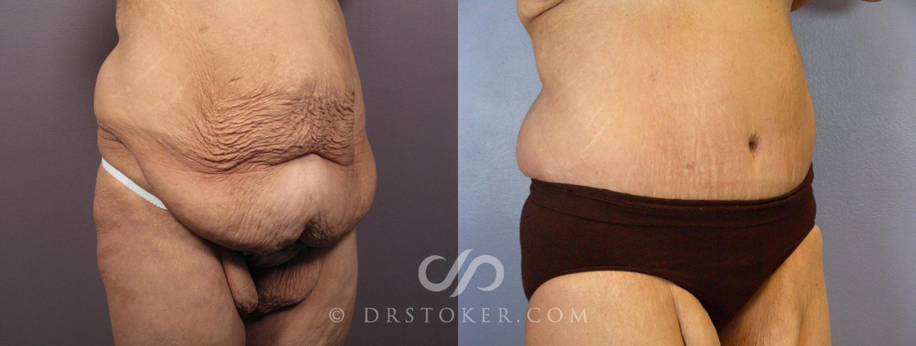 Before & After Tummy Tuck Case 119 View #2 View in Los Angeles, CA