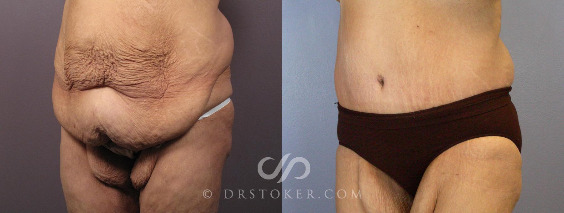 Before & After Tummy Tuck Case 119 View #3 View in Los Angeles, CA