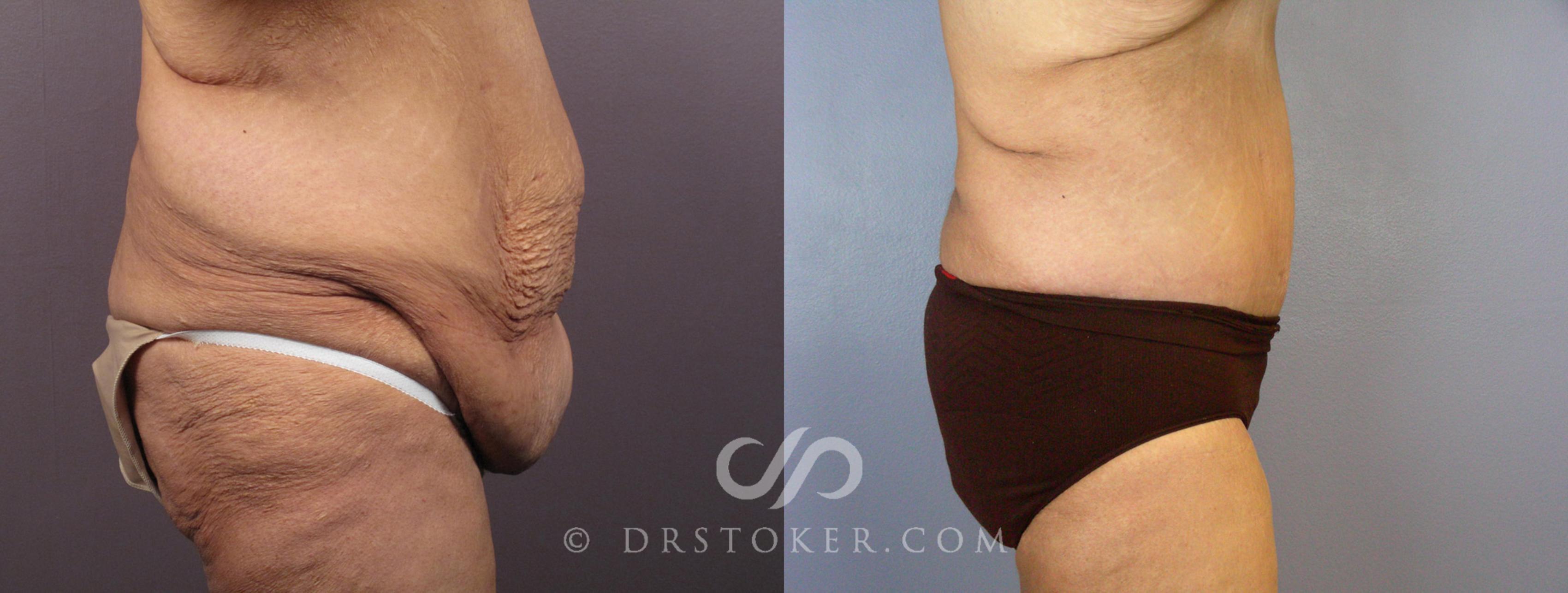 Before & After Tummy Tuck Case 119 View #4 View in Los Angeles, CA