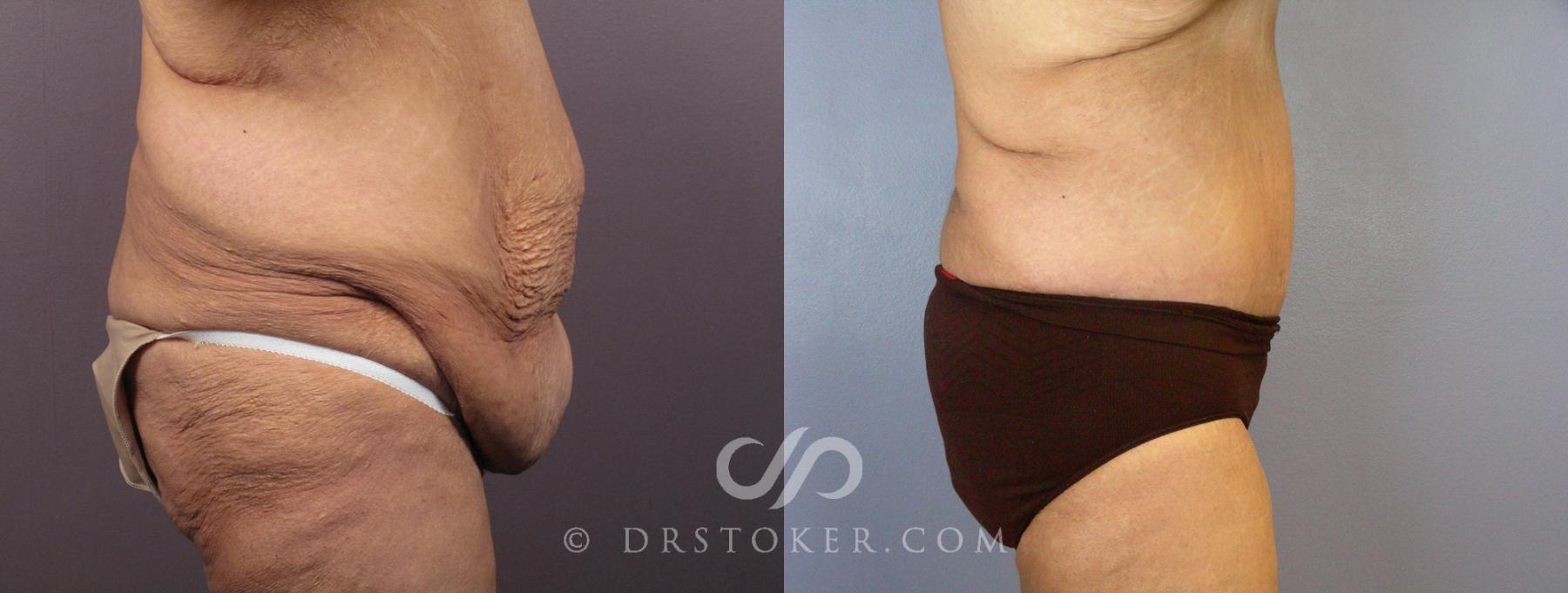 Before & After Tummy Tuck Case 119 View #4 View in Los Angeles, CA