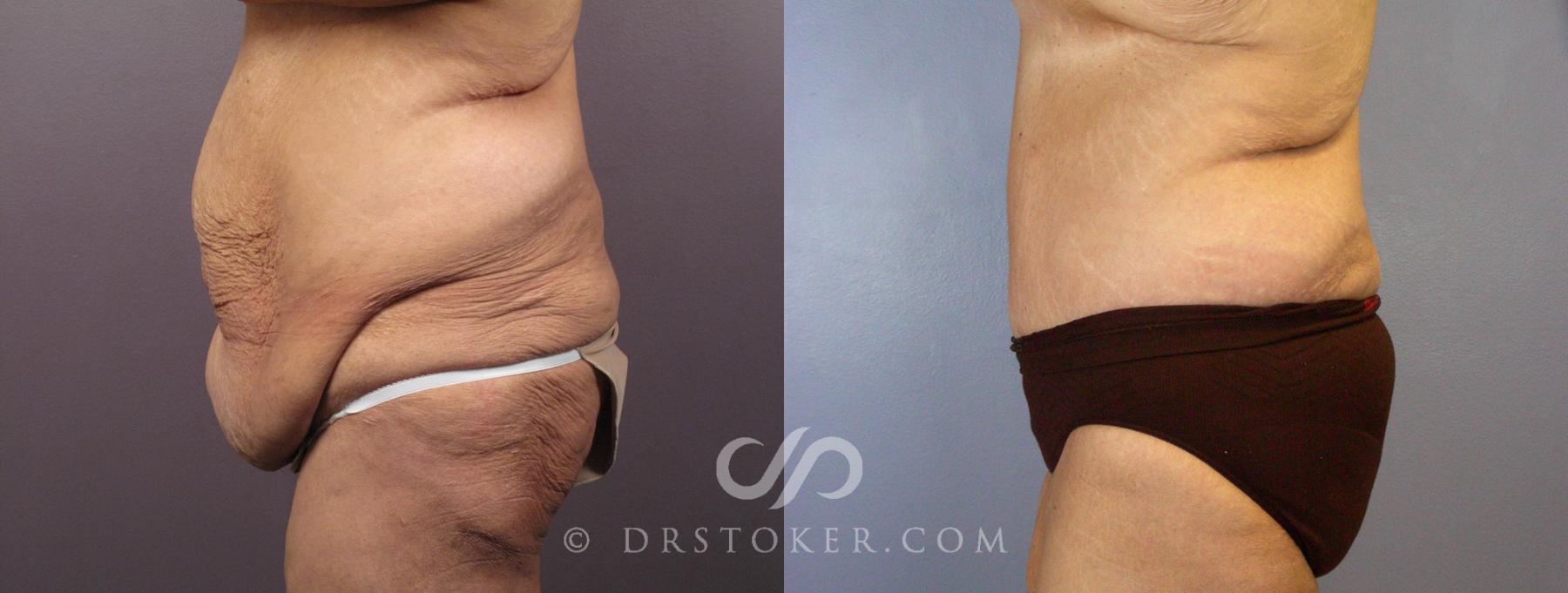 Before & After Tummy Tuck Case 119 View #5 View in Los Angeles, CA