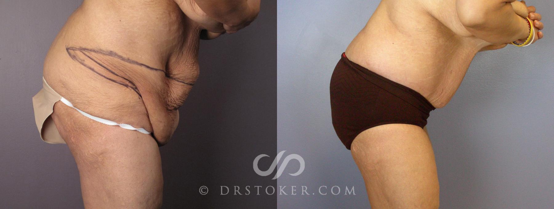 Before & After Tummy Tuck Case 119 View #6 View in Los Angeles, CA