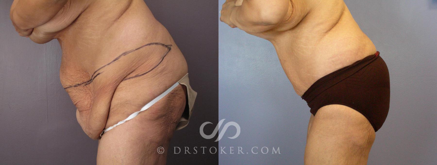 Before & After Tummy Tuck Case 119 View #7 View in Los Angeles, CA