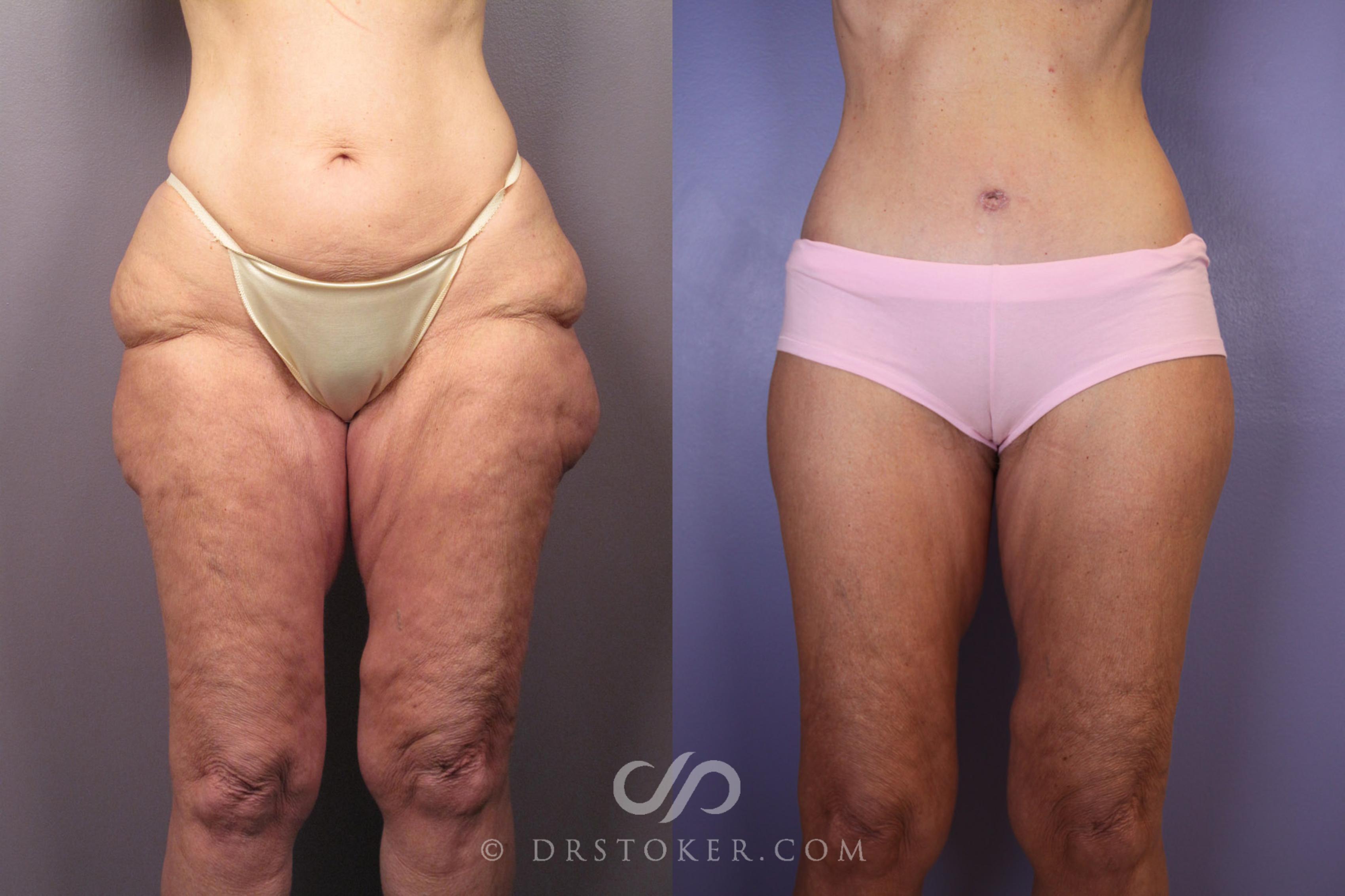 Before & After Tummy Tuck Case 120 View #1 View in Los Angeles, CA
