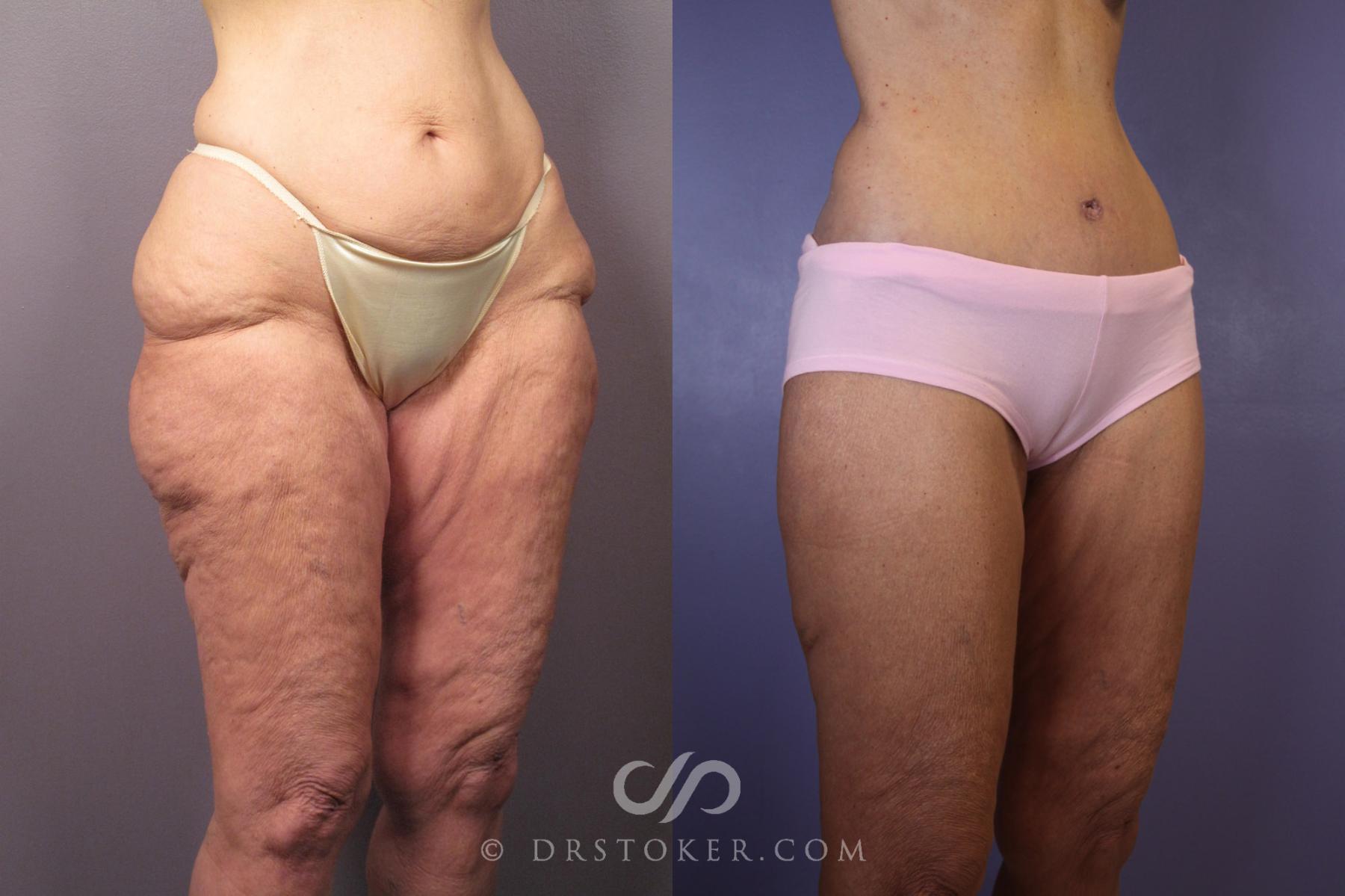 Before & After Tummy Tuck Case 120 View #2 View in Los Angeles, CA