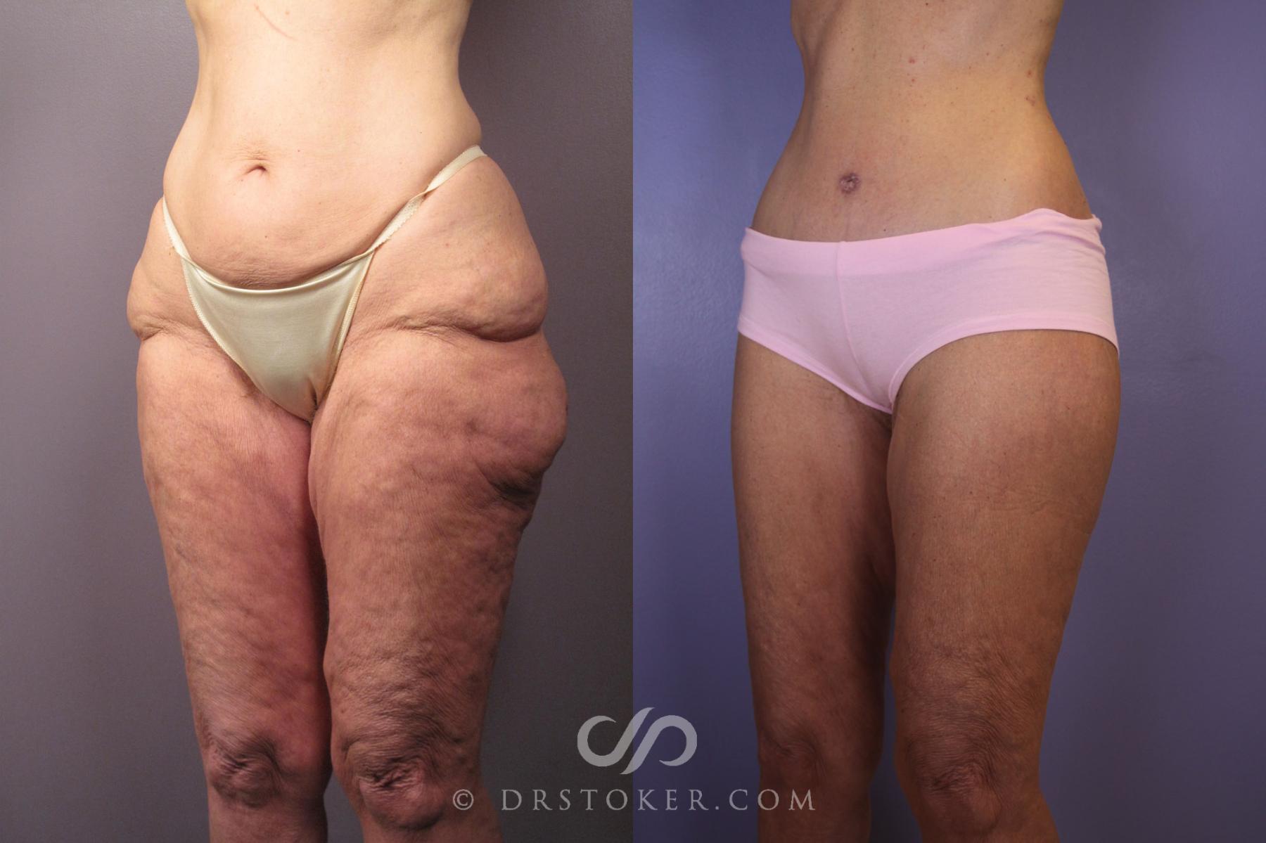 Before & After Tummy Tuck Case 120 View #3 View in Los Angeles, CA