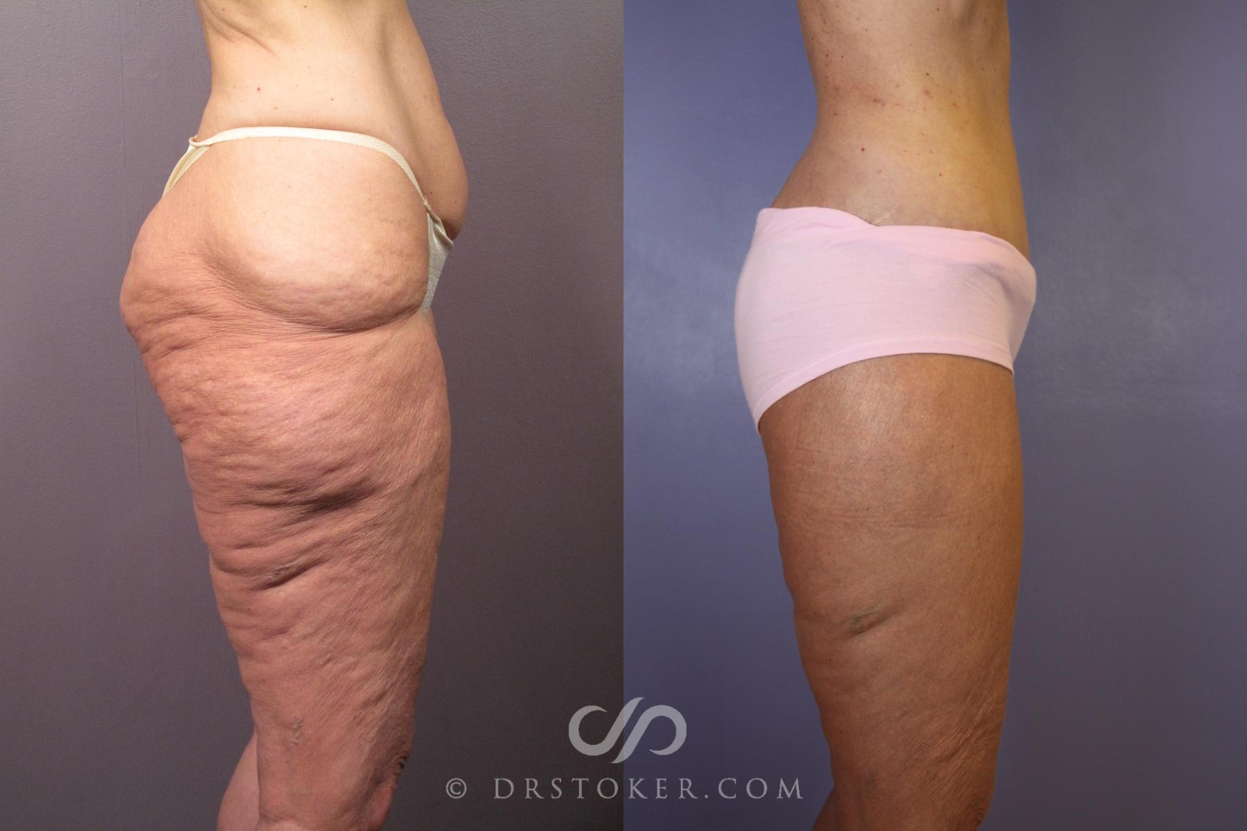 Before & After Tummy Tuck Case 120 View #4 View in Los Angeles, CA