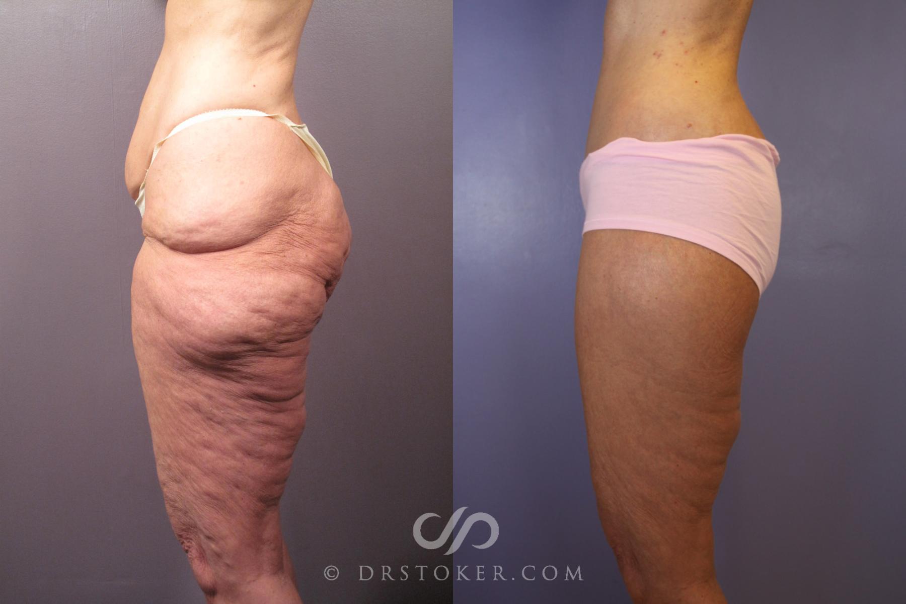 Before & After Tummy Tuck Case 120 View #5 View in Los Angeles, CA