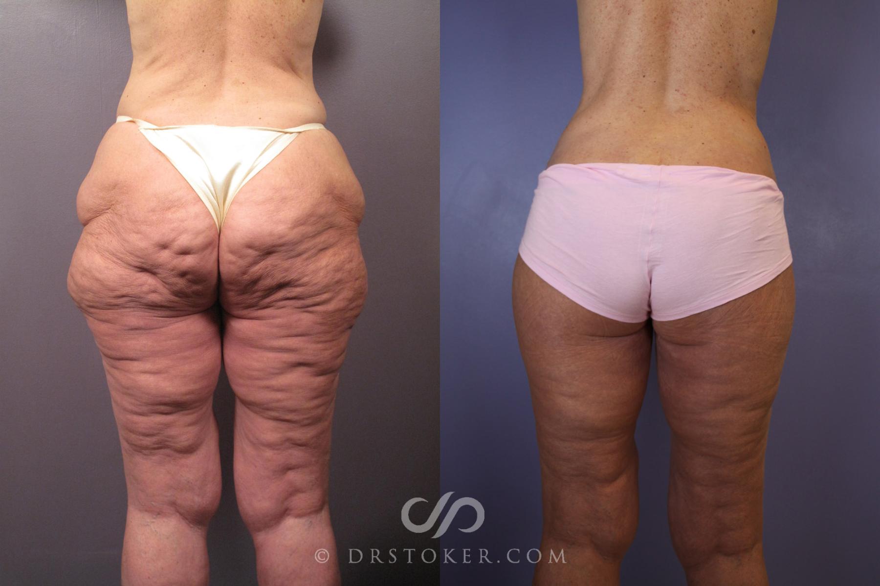 Before & After Tummy Tuck Case 120 View #6 View in Los Angeles, CA