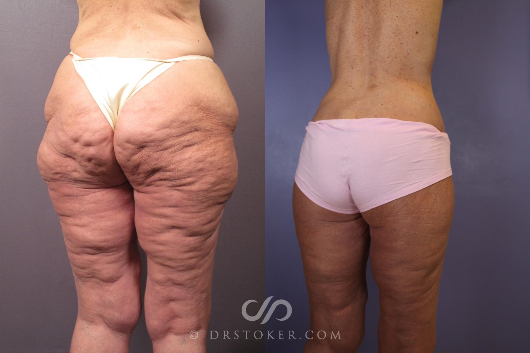 Before & After Tummy Tuck Case 120 View #7 View in Los Angeles, CA