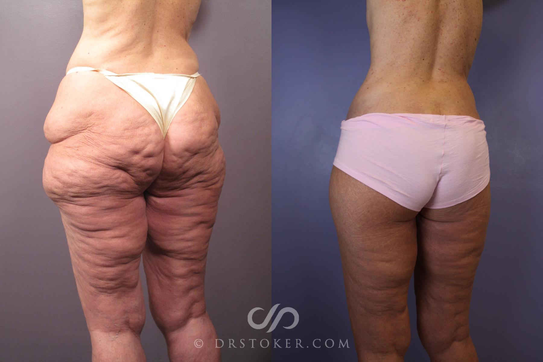 Before & After Tummy Tuck Case 120 View #8 View in Los Angeles, CA