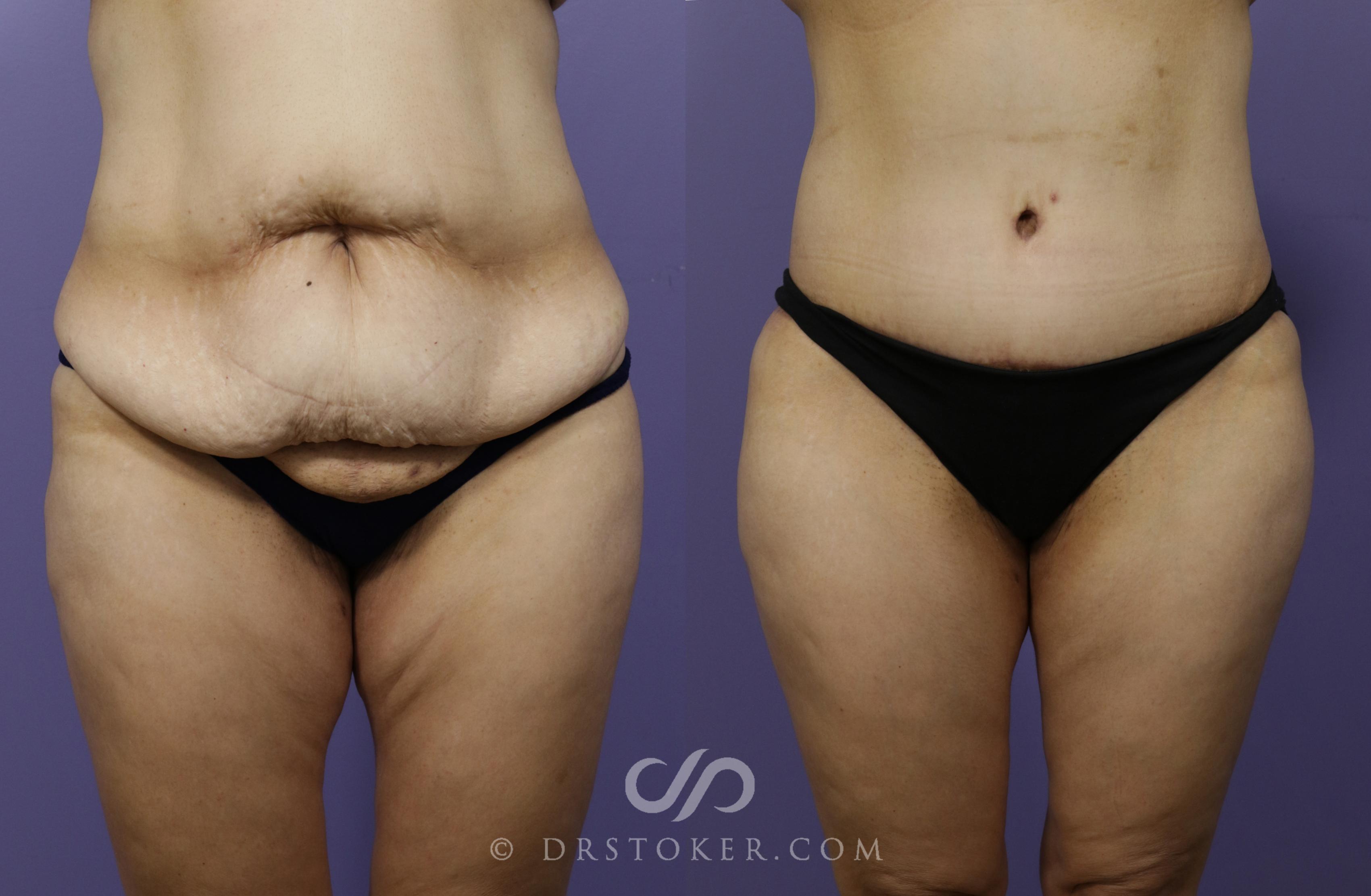 Before & After Tummy Tuck Case 1359 View #1 View in Los Angeles, CA