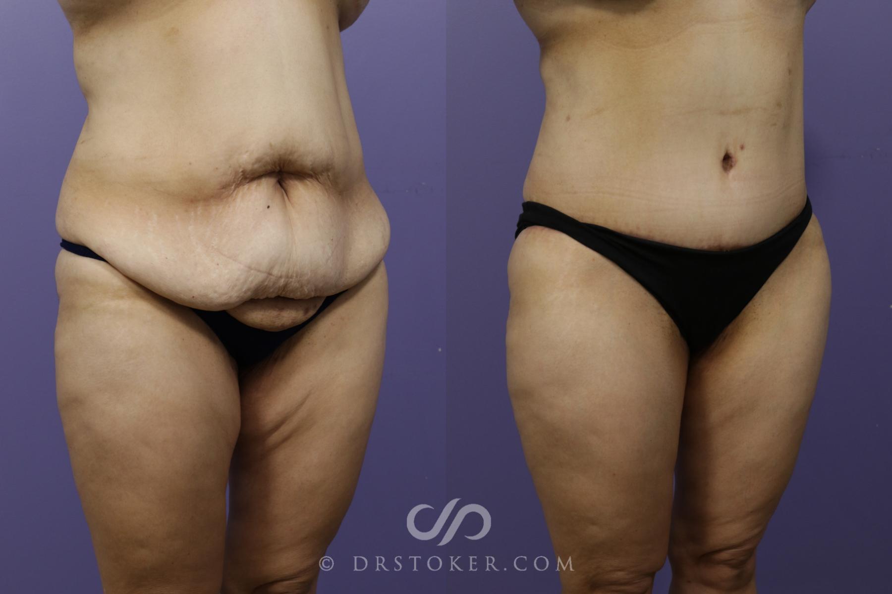 Before & After Tummy Tuck Case 1359 View #2 View in Los Angeles, CA