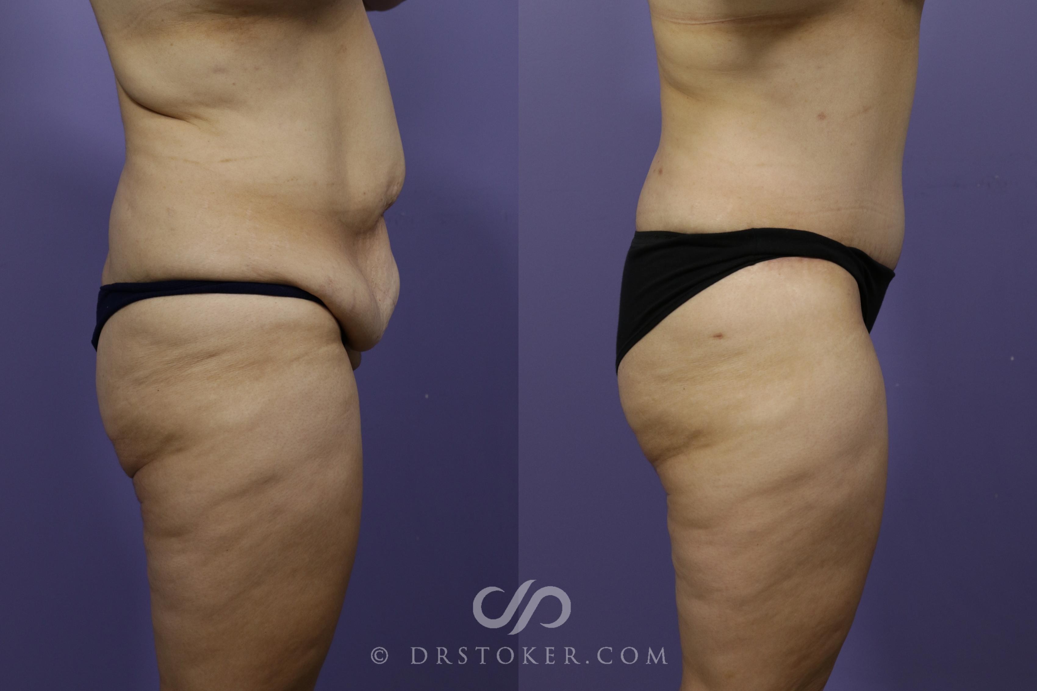 Before & After Tummy Tuck Case 1359 View #3 View in Los Angeles, CA