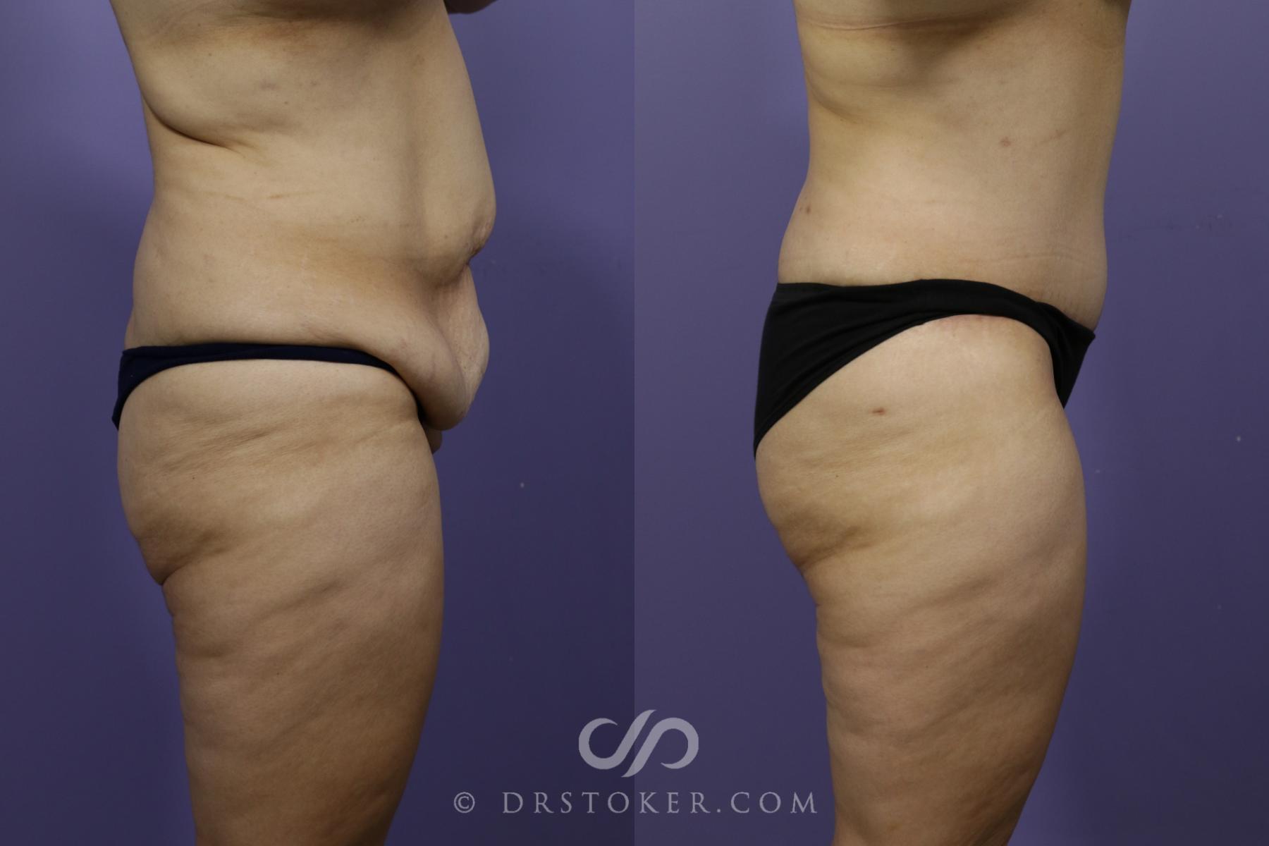 Before & After Tummy Tuck Case 1359 View #3 View in Los Angeles, CA