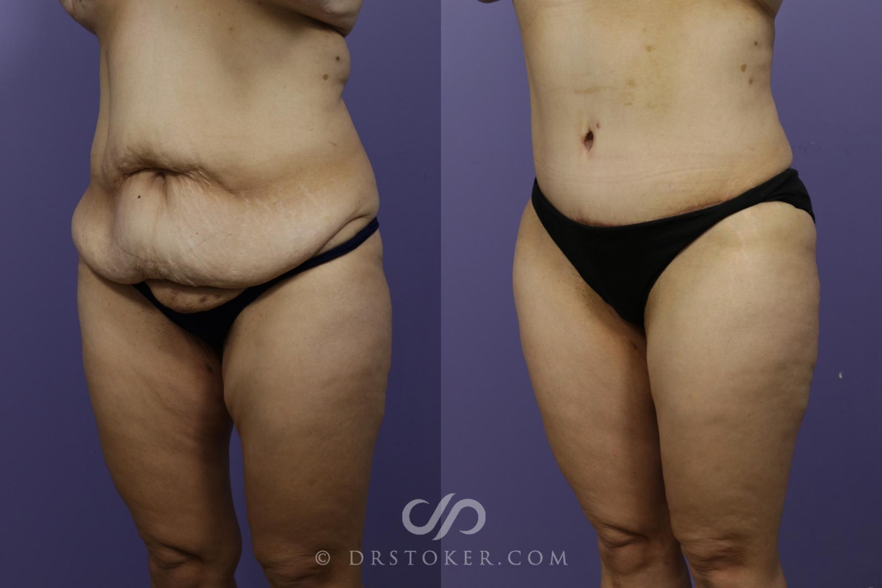 Before & After Tummy Tuck Case 1359 View #4 View in Los Angeles, CA