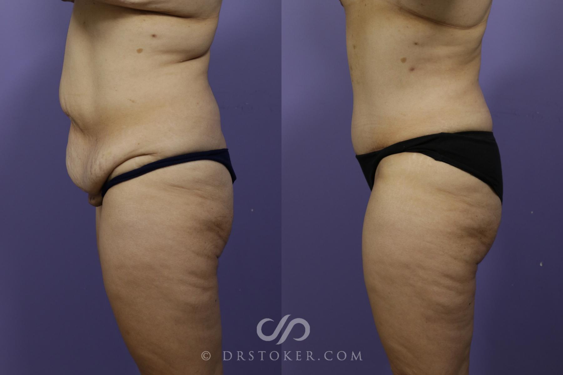 Before & After Tummy Tuck Case 1359 View #5 View in Los Angeles, CA