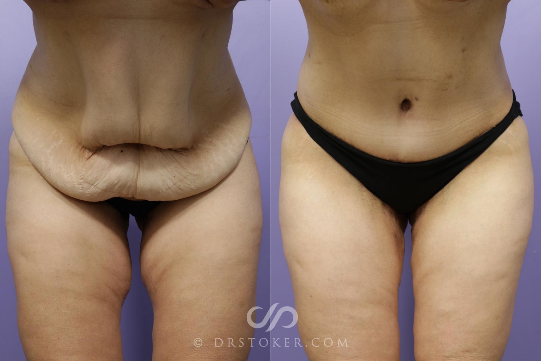 Before & After Tummy Tuck Case 1359 View #6 View in Los Angeles, CA